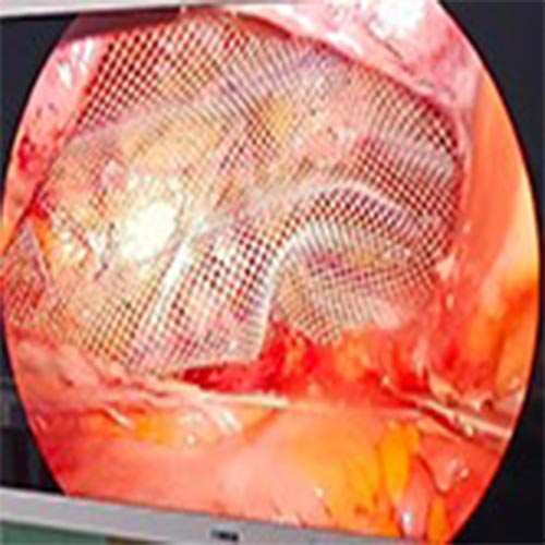 Surgical Medical Endoscopy Camera Systems In Uttarakhand